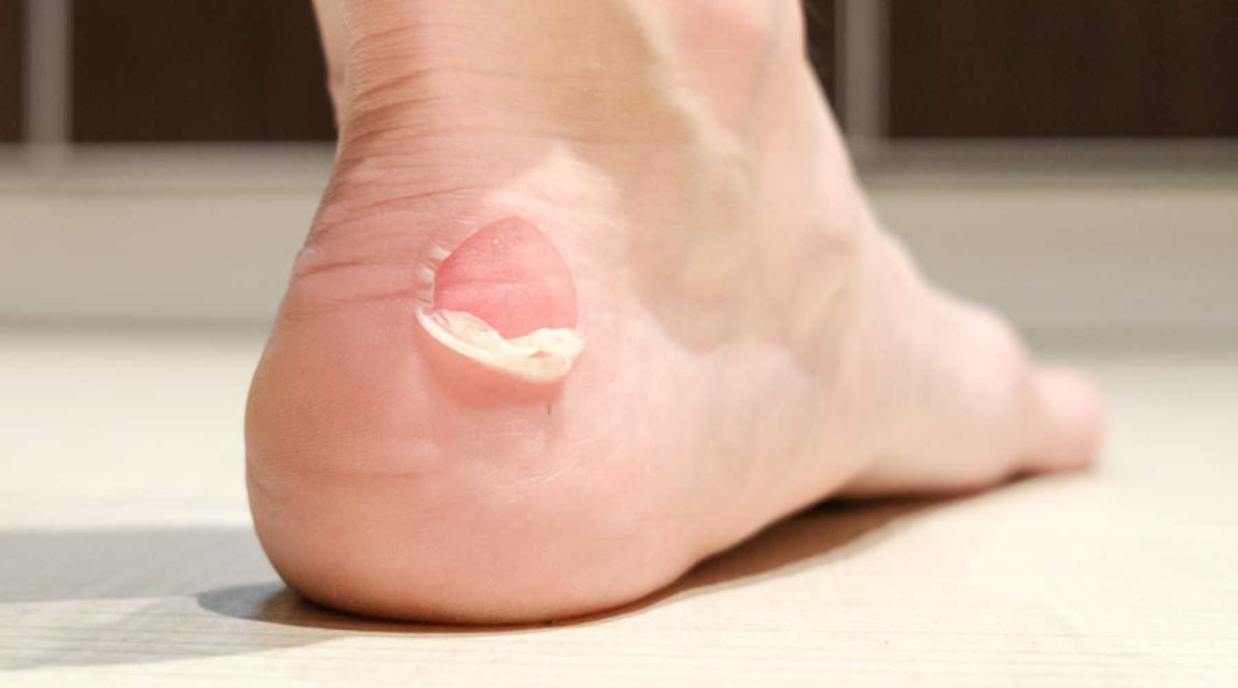 3 Injuries to Prevent by Wearing Grip Socks
